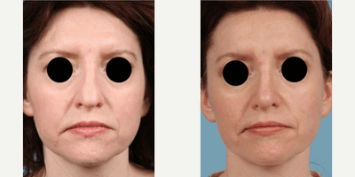 Case 3393 - Woman treated with Rhinoplasty