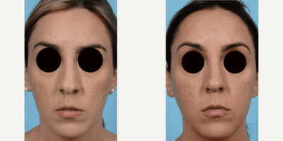 Case 3430 - Woman treated with Rhinoplasty