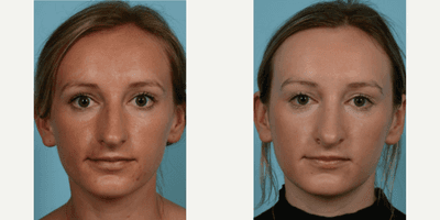 Case 3431 - Woman treated with Rhinoplasty