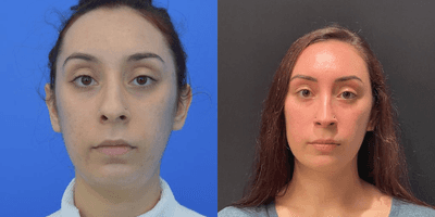 Case 3432 - Woman treated with Rhinoplasty