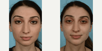 Case 3468 - Woman treated with Rhinoplasty