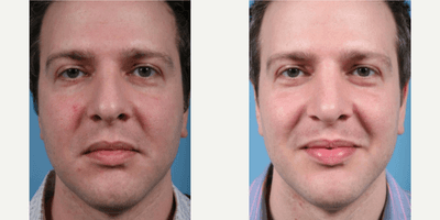 Case 3473 - Man treated with Rhinoplasty