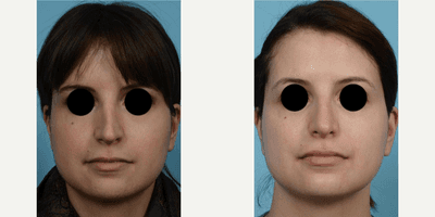Case 3482 - Woman treated with Rhinoplasty