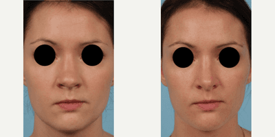 Case 3483 - Woman treated with Rhinoplasty