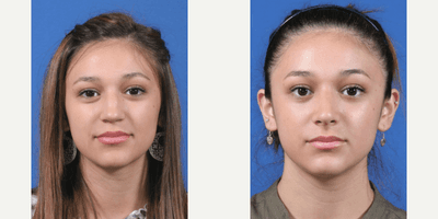 Case 3493 - Rhinoplasty