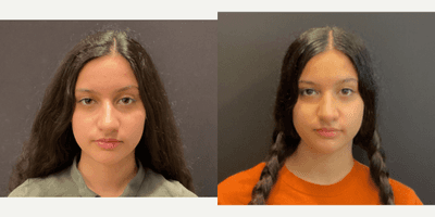 Case 3494 - 18-24 year old woman treated with Rhinoplasty