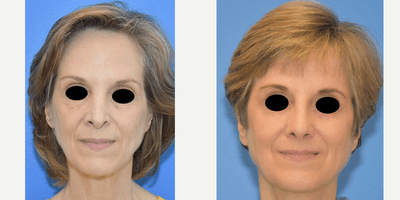 Case 3583 - 55-64 year old woman treated with Rhinoplasty