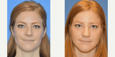 Case 3585 - 18-24 year old woman treated with Rhinoplasty