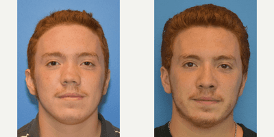 Case 3587 - 25-34 year old man treated with Rhinoplasty