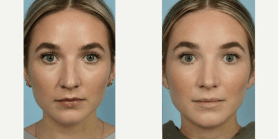 Case 3757 - 18-24 year old woman treated with Rhinoplasty