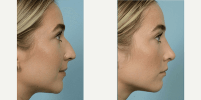 Case 3758 - 18-24 year old woman treated with Rhinoplasty