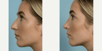 Case 3760 - 18-24 year old woman treated with Rhinoplasty