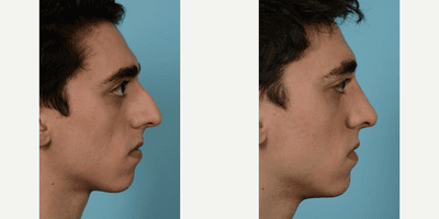 Case 3761 - 25-34 year old man treated with Rhinoplasty
