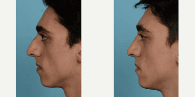 Case 3762 - 25-34 year old man treated with Rhinoplasty