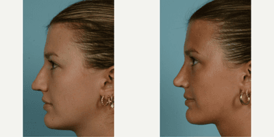 Case 3763 - 18-24 year old woman treated with Rhinoplasty