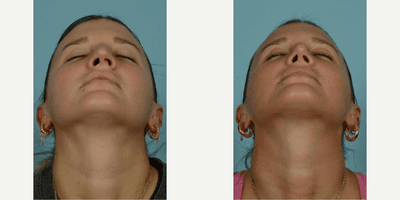 Case 3764 - 18-24 year old woman treated with Rhinoplasty