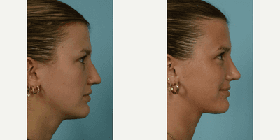Case 3765 - 18-24 year old woman treated with Rhinoplasty