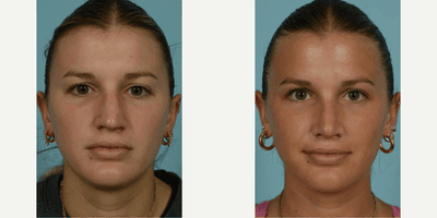 Case 3766 - 18-24 year old woman treated with Rhinoplasty