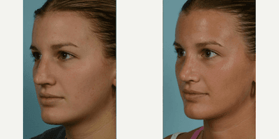 Case 3767 - 18-24 year old woman treated with Rhinoplasty