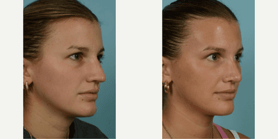 Case 3768 - 18-24 year old woman treated with Rhinoplasty