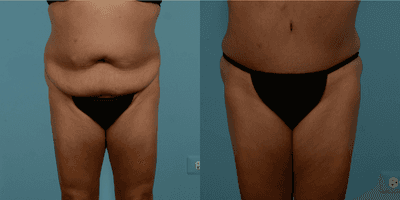 Case 383 - 55-64 year old woman treated with Tummy Tuck