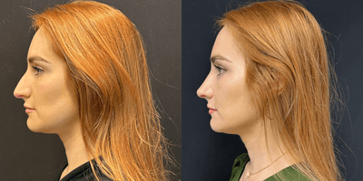 Case 3884 - Woman treated with Rhinoplasty