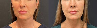Case 3893 - Woman treated with Rhinoplasty