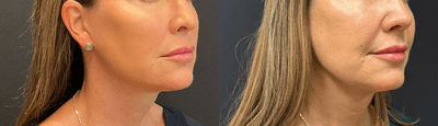 Case 3894 - Woman treated with Rhinoplasty