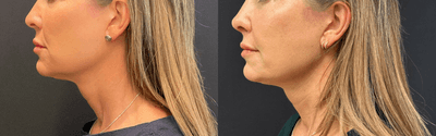 Case 3895 - Woman treated with Rhinoplasty
