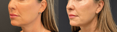 Case 3896 - Woman treated with Rhinoplasty