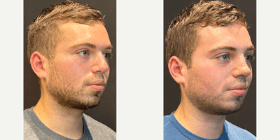 Case 3949 - Man treated with Rhinoplasty