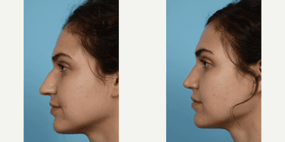 Case 4021 - Woman treated with Rhinoplasty