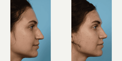 Case 4022 - Woman treated with Rhinoplasty
