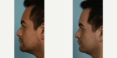 Case 4023 - Man treated with Rhinoplasty
