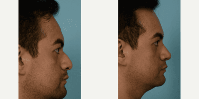 Case 4024 - Man treated with Rhinoplasty