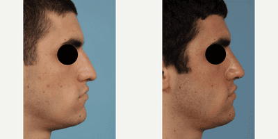 Case 4196 - Man treated with Rhinoplasty