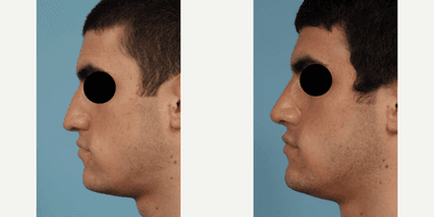Case 4197 - Man treated with Rhinoplasty