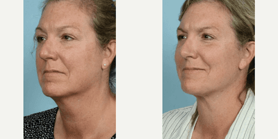 Case 4198 - Woman treated with Rhinoplasty, Eyelid Surgery