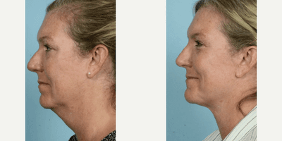 Case 4199 - Woman treated with Rhinoplasty, Eyelid Surgery