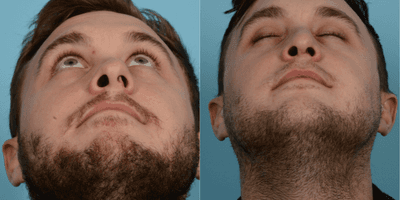 Case 4384 - 25-34 year old man treated with Rhinoplasty