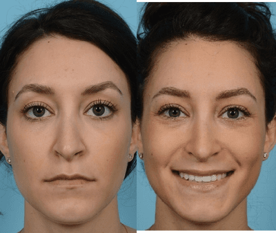 Case 4397 - Woman treated with Rhinoplasty
