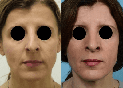 Case 4398 - Woman treated with Rhinoplasty
