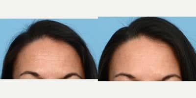 Case 4464 - 45-54 year old woman treated with Botox