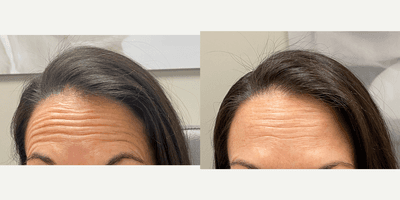 Case 4465 - 45-54 year old woman treated with Botox
