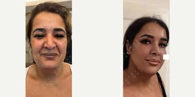 Case 4658 - Woman treated with Chin Liposuction, Lip Fillers, Botox