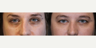 Case 5200 - Woman treated with Botox