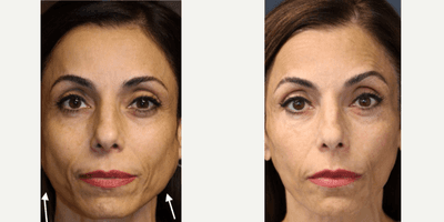 Case 5232 - Woman treated with Botox