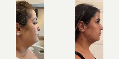 Case 5613 - Woman treated with Chin Liposuction, Lip Fillers, Botox