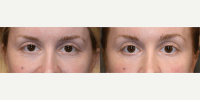 Case 5717 - Dissolution of Misplaced Filler with Laser and Botox