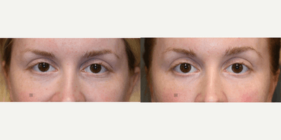 Case 5718 - Dissolution of Misplaced Filler with Laser and Botox